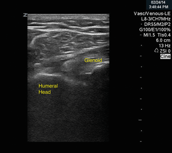 Image 2. Post-reduction ultrasound of the shoulder joint, showing the humeral head again in close proximity to the glenoid.