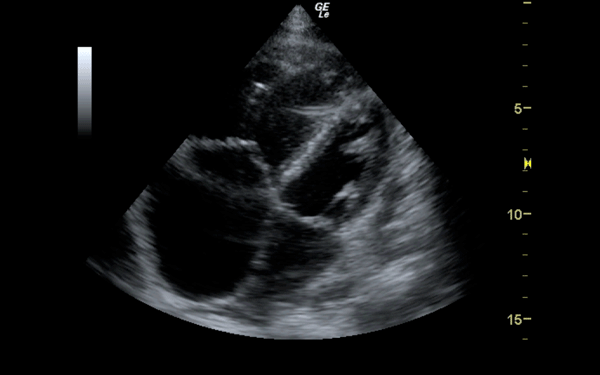 Figure 1 Figure 1. RV dilation and strain during systole. Right heart is to the left of the image and left heart is to the right.