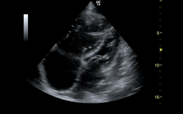 Figure 2 Figure 2. RV dilation and strain during diastole, with visible bowing of the interventricular septum.
