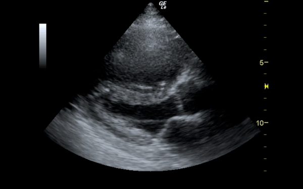 Figure 3 Figure 3. RV dilation with septal bowing of the interventricular septum into the LV outflow tract.
