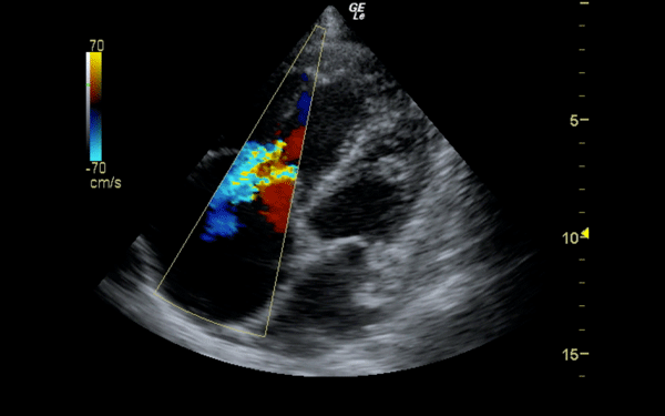 Figure 4 Figure 4. Evidence of tricuspid regurgitation on Doppler color flow, in a setting of increased RV load.