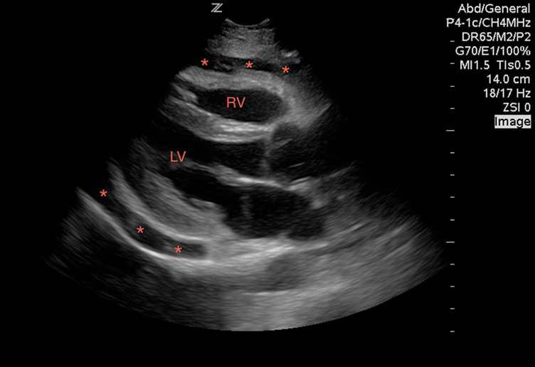 Figure 1 Image 1. A large pericardial effusion (*) with tamponade physiology.