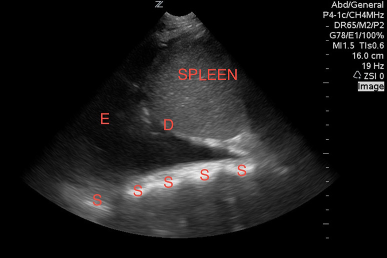 Figure 10 Image 10. A large pleural effusion (E) visualized above the diaphragm (D) with a spine sign (S). A floating lung is not visualized in this image.