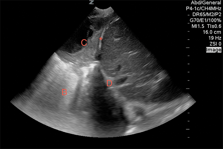 Figure 11 Image 11. A pulmonary consolidation (C) with a diffuse B-line pattern (B) visualized above the liver (L) and diaphragm (D).