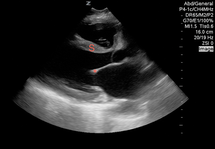Figure 2 Image 2. A poorly contracting heart in the setting of decompensated heart failure. The anterior leaflet of the mitral valve (*) does not come close to the inter-ventricular septum (S) during diastole, demonstrating a severely depressed EF.