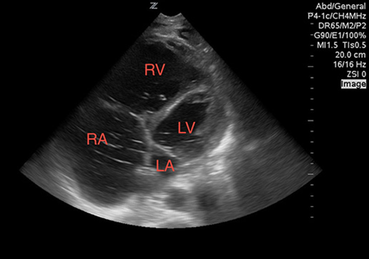Figure 3 Image 3. A dilated right ventricle (RV) and atrium (RA), as compared to the left ventricle (LV) and atrium (LA). Seen in the setting of a pulmonary embolism.