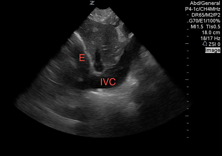 Figure 4 Image 4. A distended IVC with a pericardial effusion (E), consistent with tamponade physiology.