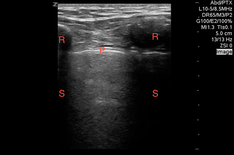 Figure 5 Image 5. With the linear array probe, the pleura (P) can be seen sliding between two ribs (R), which demonstrates posterior shadowing (S).
