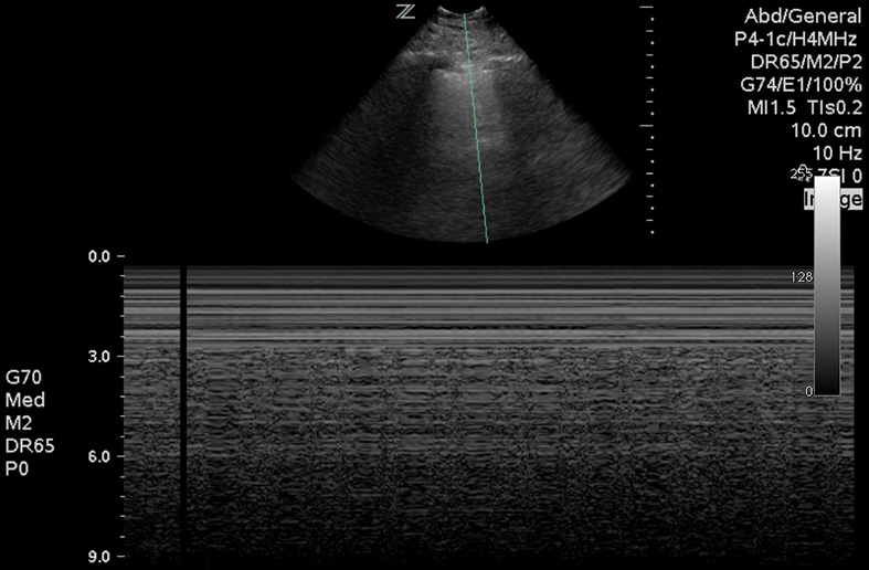 Figure 6 Image 6. The seashore sign with M-mode, demonÂstrating normal lung movement.