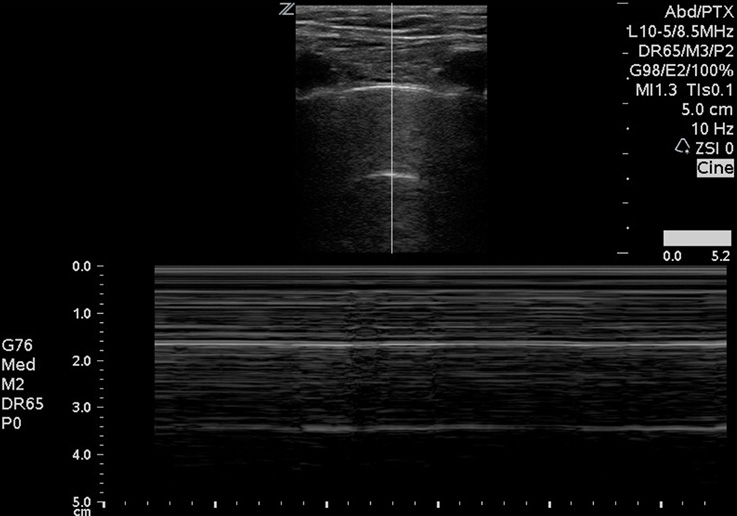 Figure 7 Image 7. The barcode sign demonstrating a pneumothorax with M-mode.