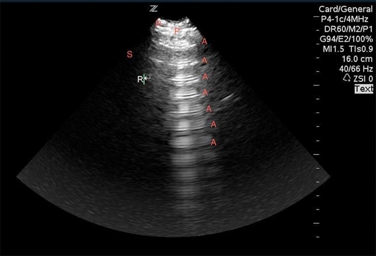 Figure 8 Image 8. Normal lung ultrasound, demonstrating A-lines (A) reverberating from the pleura (P) between two ribs (R).