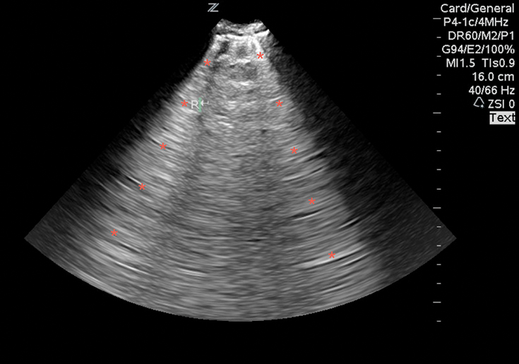 Figure 9 Image 9. Lung ultrasound on a patient with pulmonary edema and B-lines (*).