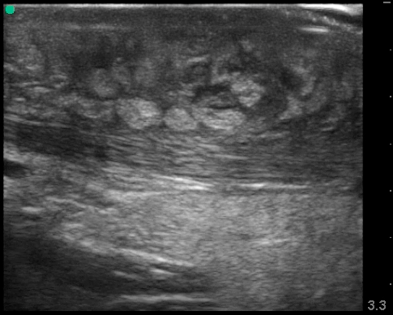 Figure 1 - Cellulitis A Image 1. Ultrasound showing the typical “cobblestone” appearance of a superficial cellulitis.