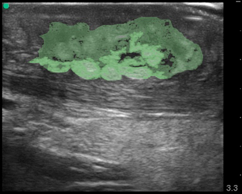 Figure 2 - Cellulitis B Image 2. Same image with adipose tissue in light green, and cellulitic fluid in darker green.