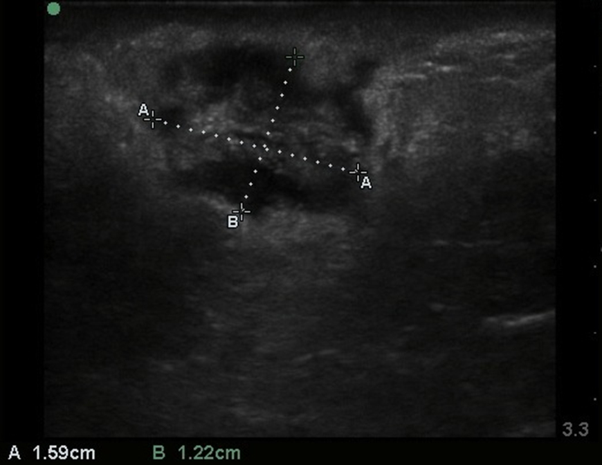 Figure 3 - abscess Image 3. Abscess with size delineated and varying echogenicity consistent with an evolving abscess.
