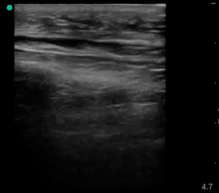 Figure 4 - Nec Fasc A Image 4. Ultrasound consistent with necrotizing fasciitis, with fluid tracking along fascial planes.