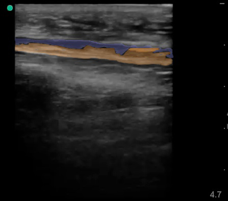 Figure 5 - Nec Fasc B Image 5. Same image of necrotizing fasciitis with fascia in orange and fluid in purple.