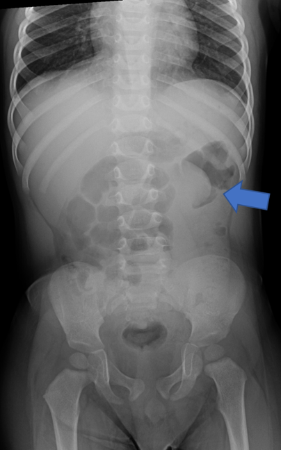 Intussusception - Fig 1.png