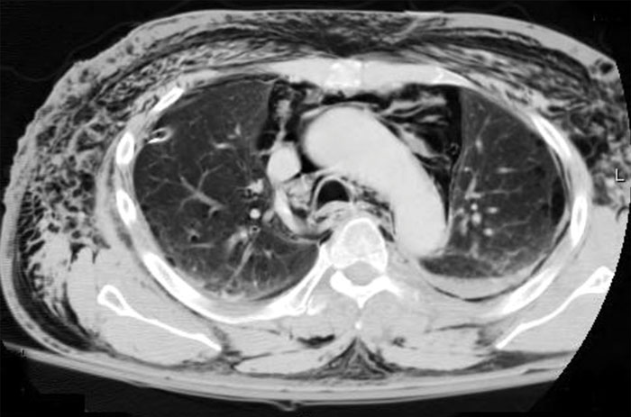Clinical-Pneumomediastinum.jpg
