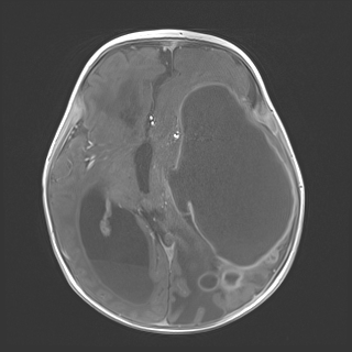 Pediatric Brain Abscess - Fig 3.png