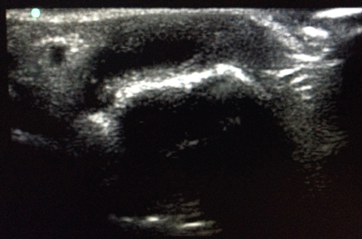 Image 1 Image 1. Short axis view of MCP joint with effusion present.