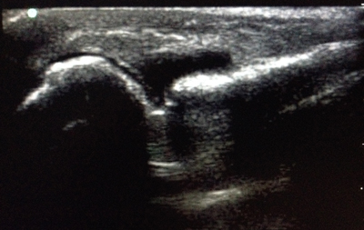 Image 2 Image 2. Long axis view of MCP joint with effusion present.