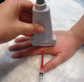 Image 5 Image 5. Transducer in long axis on index MCP joint with needle entering.
