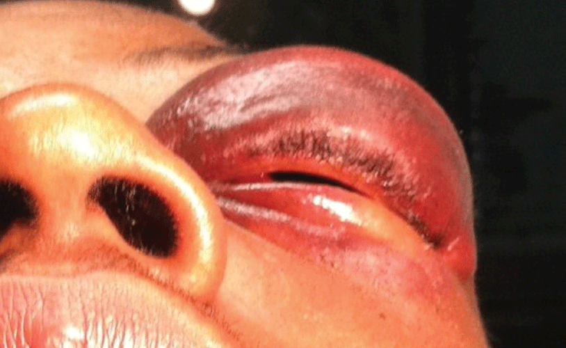 Image 1 Image 1. Left lid ecchymosis and edema after blunt orbital trauma. This patient reported tripping and falling forward onto the corner of the kitchen counter, resulting in swelling, discoloration, decreased vision, and inability to open the lids.