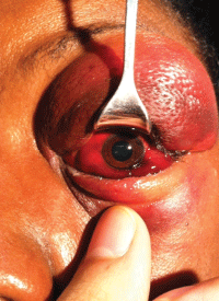 Image 2 Image 2. The same patient from Image 1. Because of the severe lid edema, a lid retractor is used to visualize the globe.
