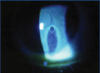 Image 3 Image 3. Positive Seidel test. Fluorescein staining of the intraocular contents secondary to corneal perforation.