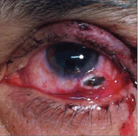 Image 4 Image 4. Globe rupture. Scleral defect (left) and close-up of the scleral rupture as seen by biomicroscopy (right).
