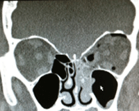 Eye-Image5 Image 5. Maxillofacial imaging demonstrating a left lamina papyracea fracture from blunt orbital trauma. From the same patient seen in images 1 and 2.