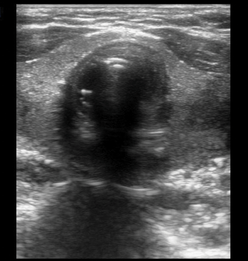 Figure 3. Image of endotracheal tube within the trachea. Note the absence of a second air-mucosal interface (hyperechoic line) adjacent to the trachea.