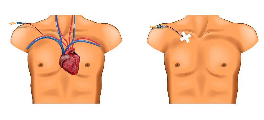 Subclavian Central Lines.jpg