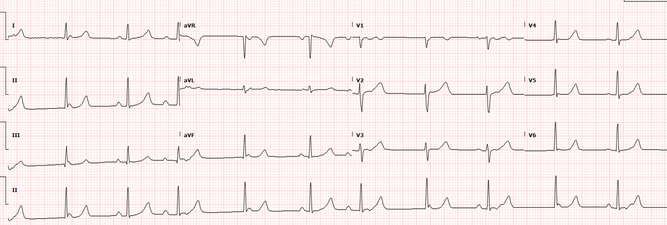 45-2_Medical Mystery - Original EKG.png