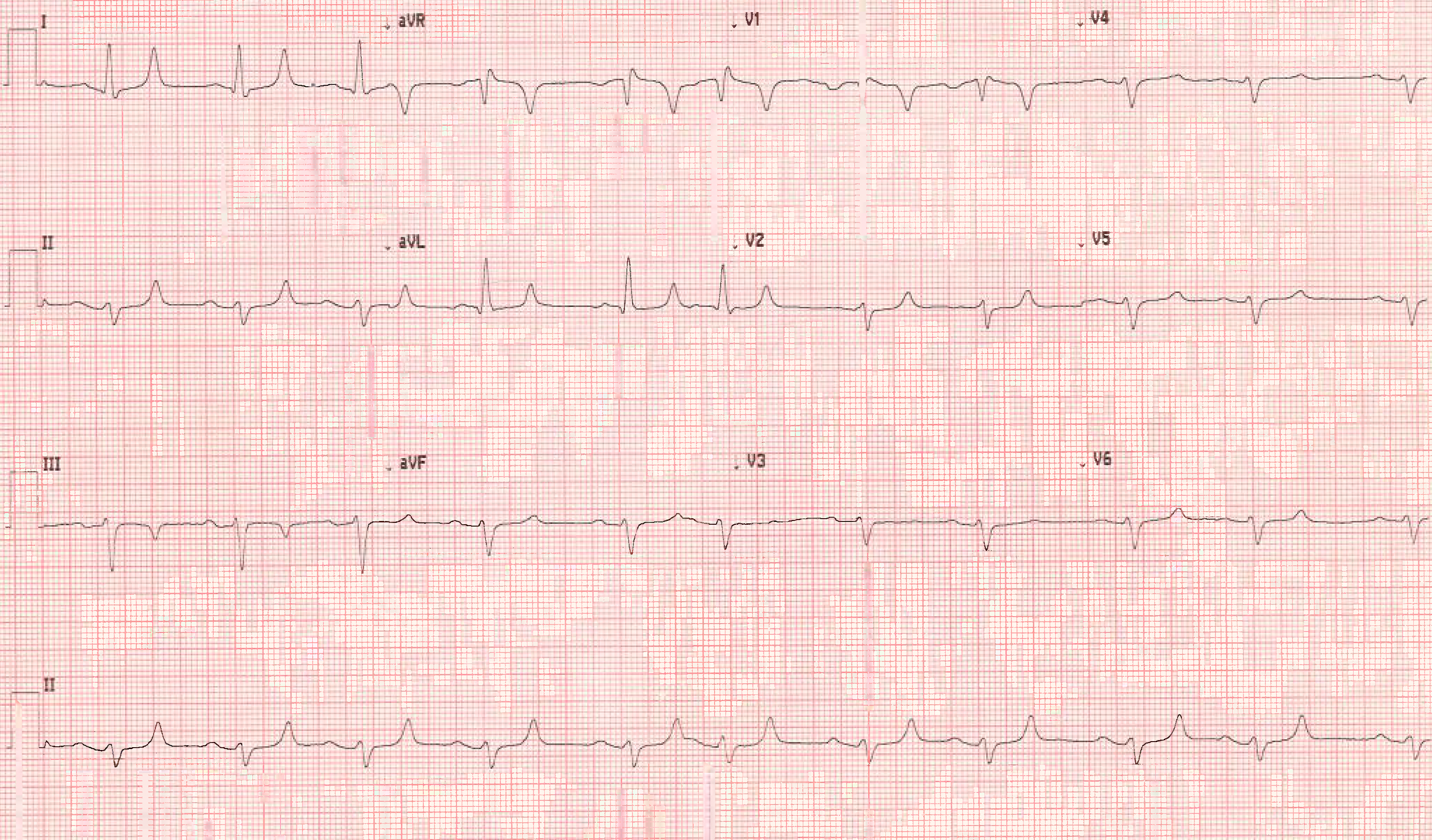 Hyperkalemia Figure 1