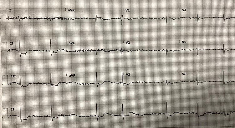 ECG Challenge
