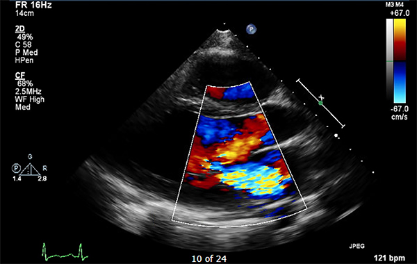 45-4_Rheumatic Heart Disease.jpg