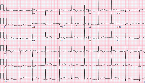 45-5 Pediatric ECG.jpg