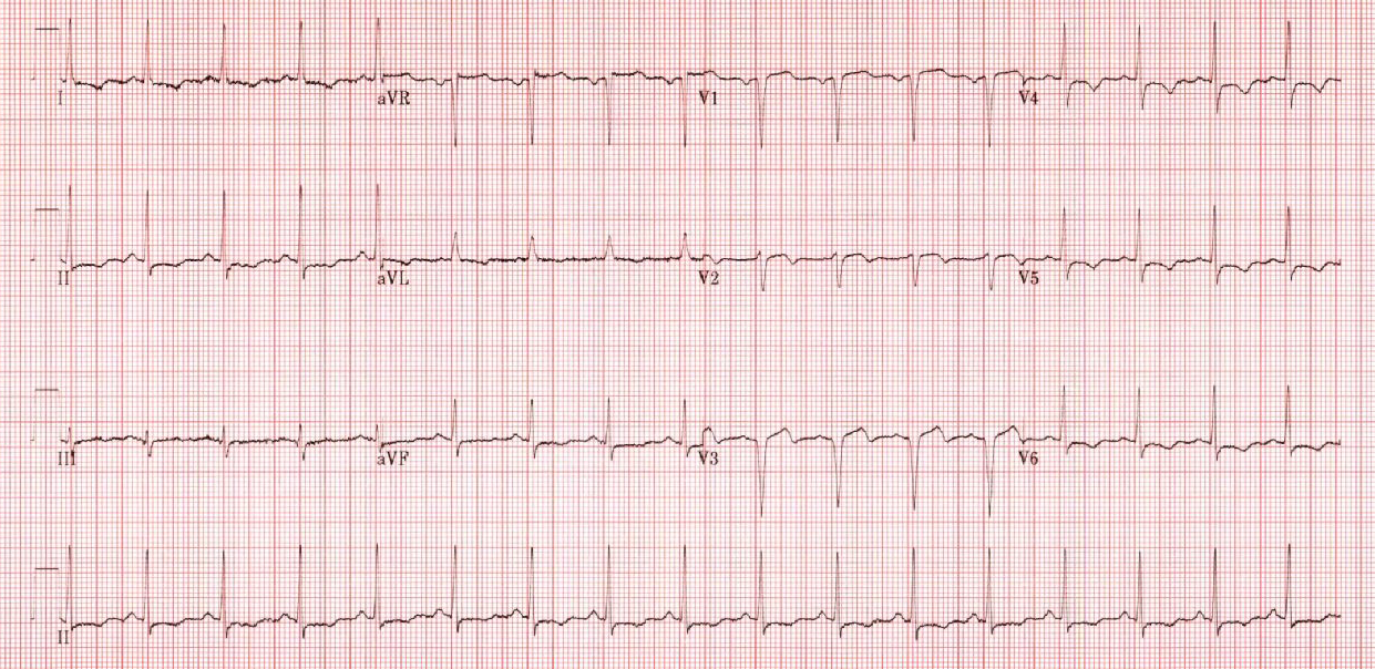 ECG Challenge: October 2018 ECG Challenge: October 2018