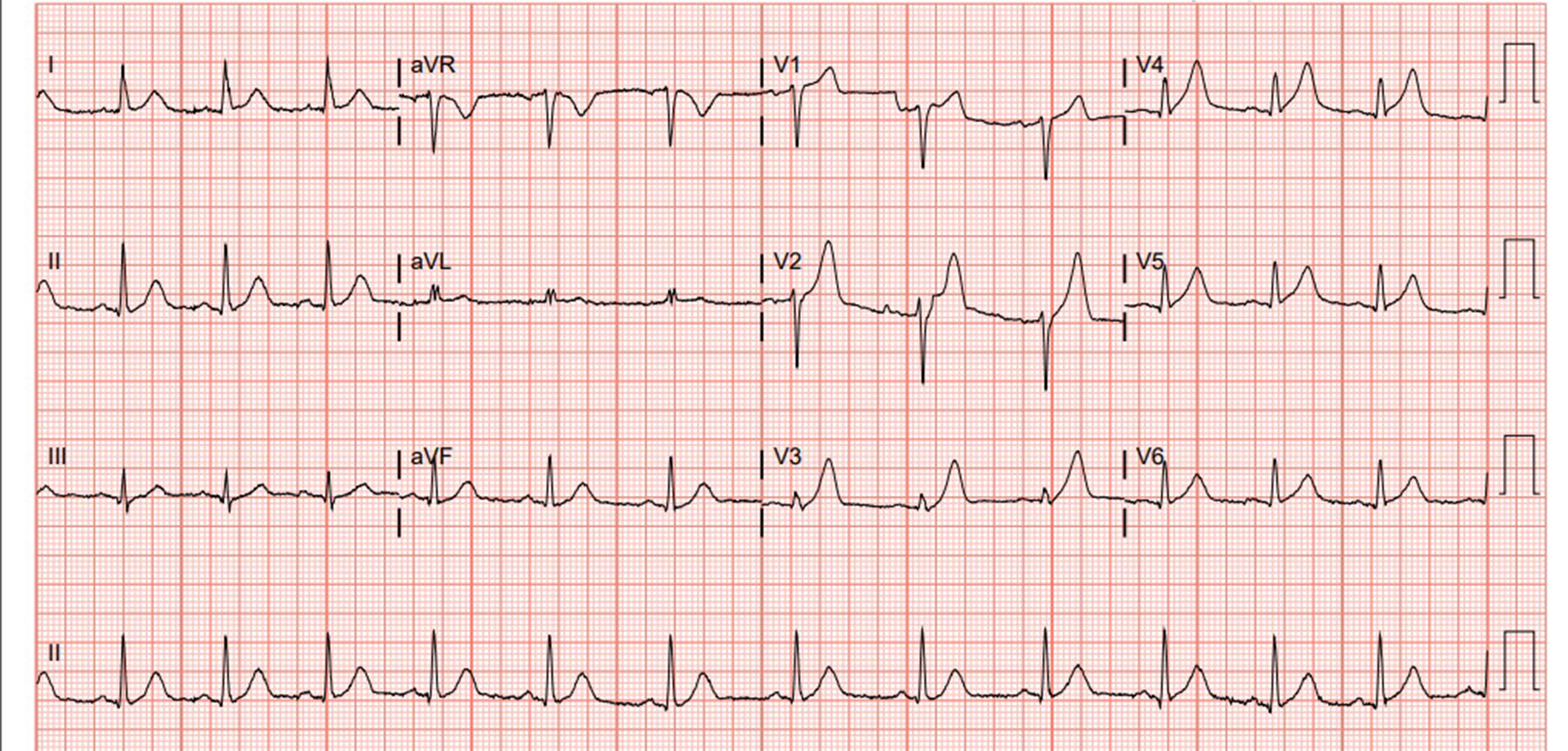 46-1 Case Report - Acute MI - EKG 1.jpg