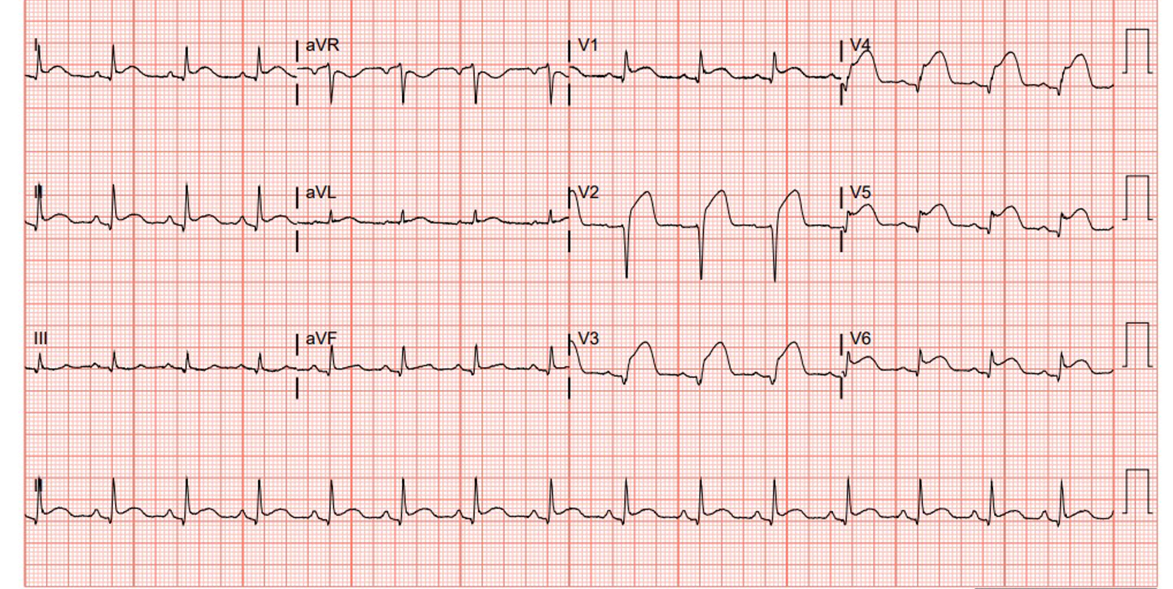 Figure 2 - Repeat EKG