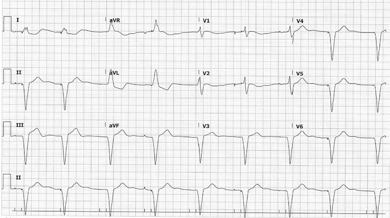 Initial ECG