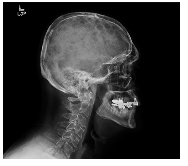 46-5 Multiple Myeloma - Lytic Lesions.jpg