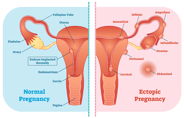 47-1 Ectopic normal_v_ectopic illustration_web.jpg