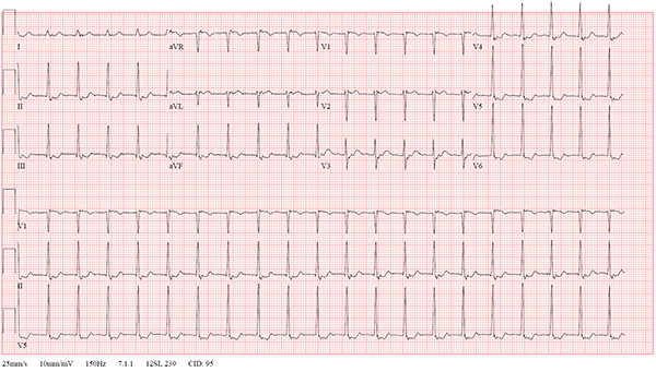 47-2 NSVT After REVERT figure-1-initial-ekg_web.jpg