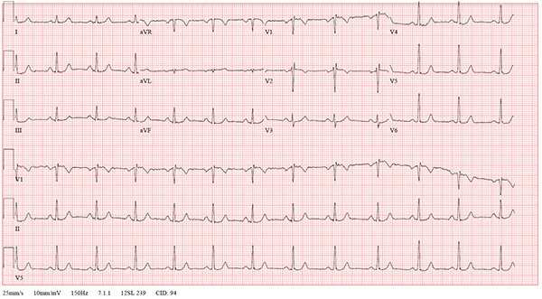 47-2 NSVT After REVERT figure-3-post-ekg_web.jpg