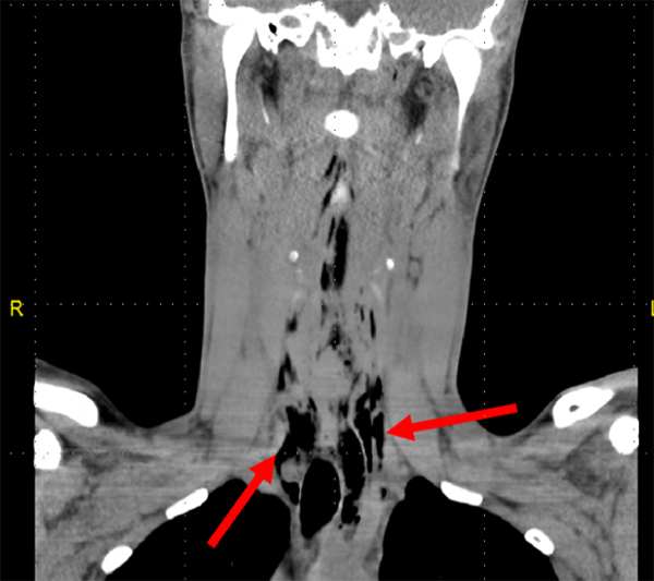 47-2 Pneumomediastinum Figure 1_web.jpg