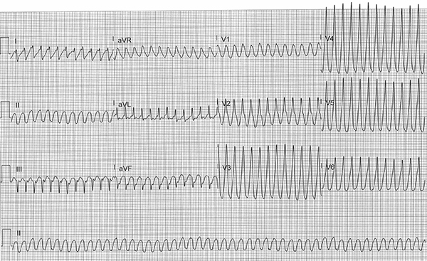 48-1 ECG Challenge - VT storm COVID.jpg