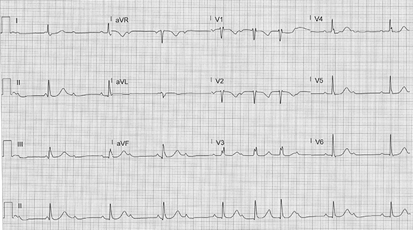 48-4 ECG Challenge - Mobitz I.jpg
